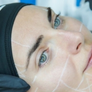 Ultrasuoni microfocalizzati ecoguidati per la pelle del viso cadente Ultrasuoni microfocalizzati ecoguidati per la pelle del viso cadente